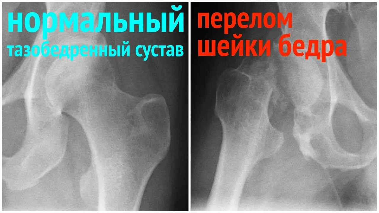 Поступь стали 5. Перелом шейки бедра походка. Шейка бедра при ходьбе. Показать расположение шейки бедра.