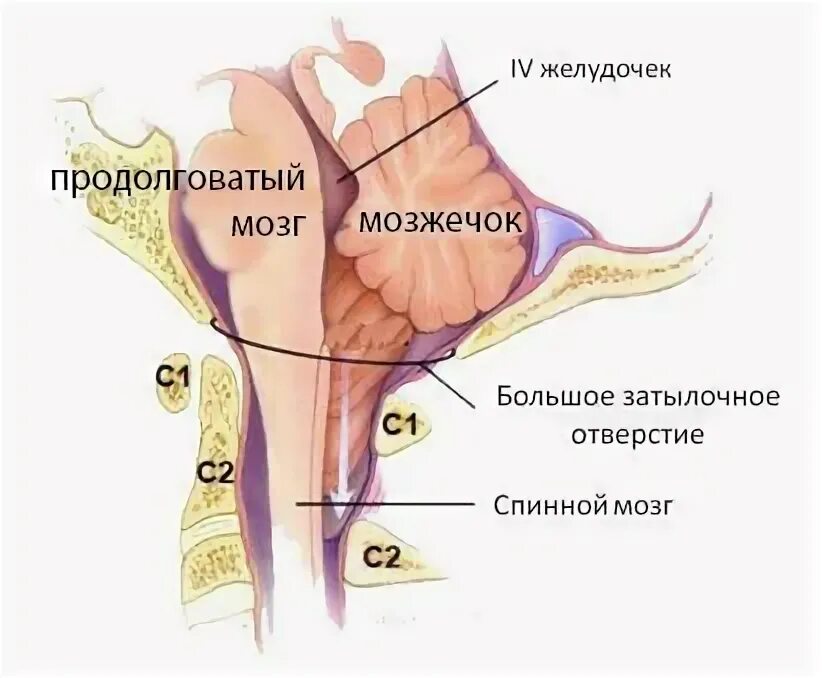 Миндалины мозжечка расположены выше уровня затылочного отверстия. Миндалины мозжечка ниже уровня большого затылочного отверстия. синдром аномалия арнольда киари. миндалины мозжечка расположены на уровне. аномалия арнольда киари с сирингомиелией.