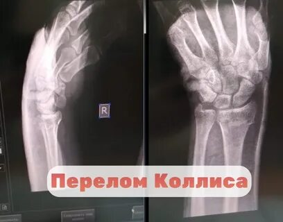Как определить перелом или трещину