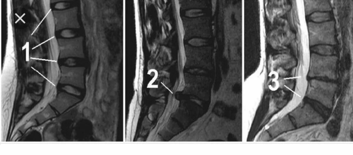 Мрт грыжа l1-l2. Экструзия диска l5-s1 что это такое. Протрузии l4 l5.