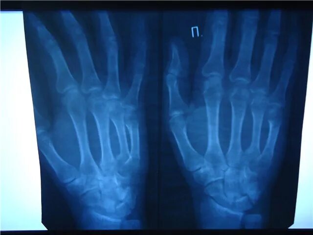 Boxer's Fracture - MEDizzy Journal
