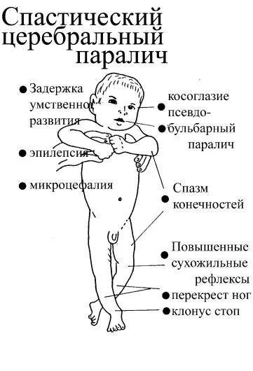 ДЦП В легкой форме симптомы у детей до года. ДЦП симптомы у детей 2 лет. Симптомы ДЦП У новорожденных в 6 месяцев. ДЦП У детей симптомы в 1. У ребенка дцп форум