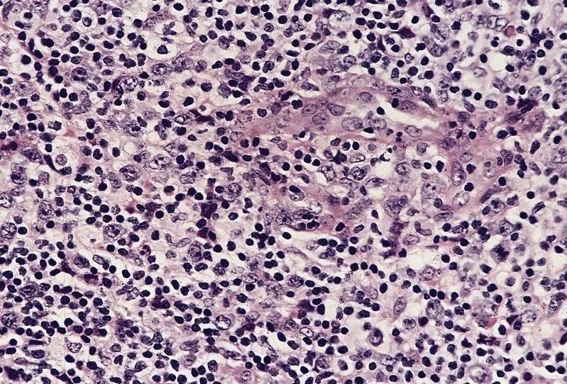 Мононуклеары гистология. Мононуклеары периферической крови. Мононуклеоз печени. Атипичные мононуклеары под микроскопом. Мононуклеары периферической крови.