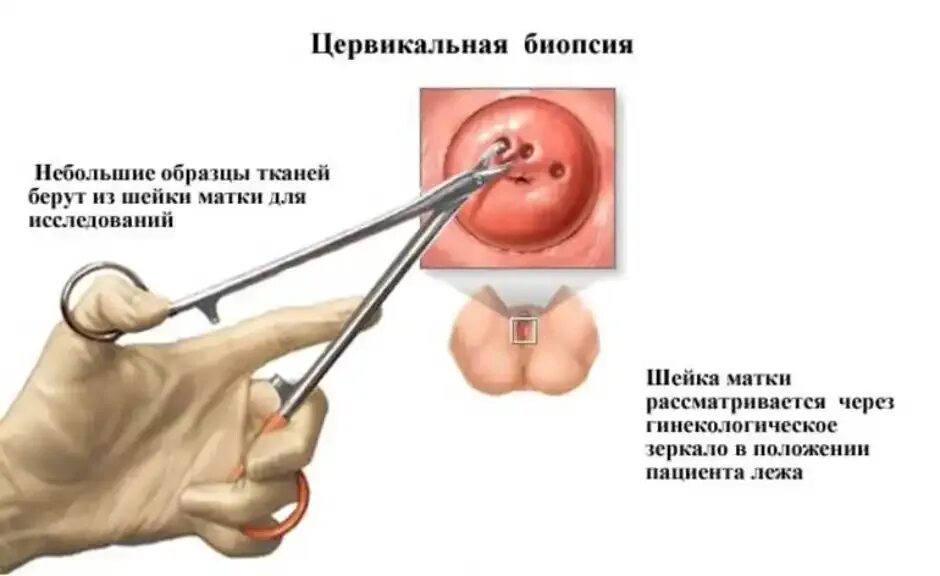 Лечение цервикального канала у женщин