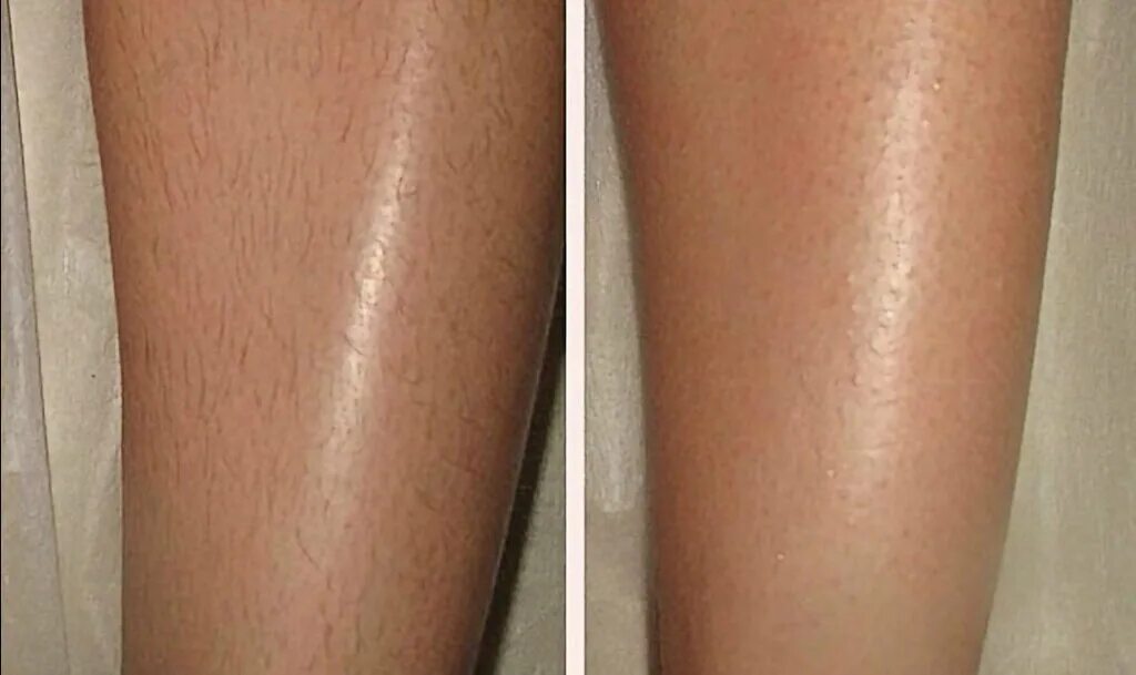 Лазерная эпиляция до и после. Лазерная эпиляция до и после. Депиляция скинс до и после. Депиляция подмышек. Депиляция воском до и после.