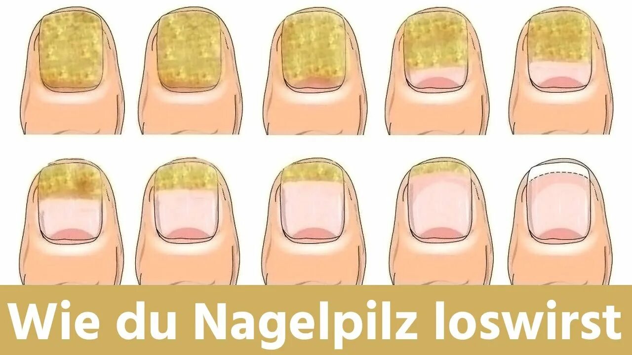 Вросший ноготь на большом пальце. Ктолщение ногтей натногах. Грибок гонится на ноге. Медленно растут ногти на ногах. Удлиненные ногти на ногах.