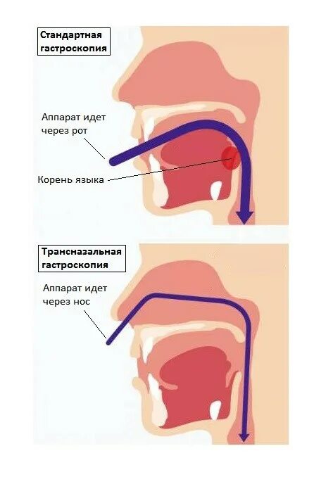 Через нос ртом делайте. Гастроэнтероскопия через нос. Гастроскопия желудка глотания зонда.