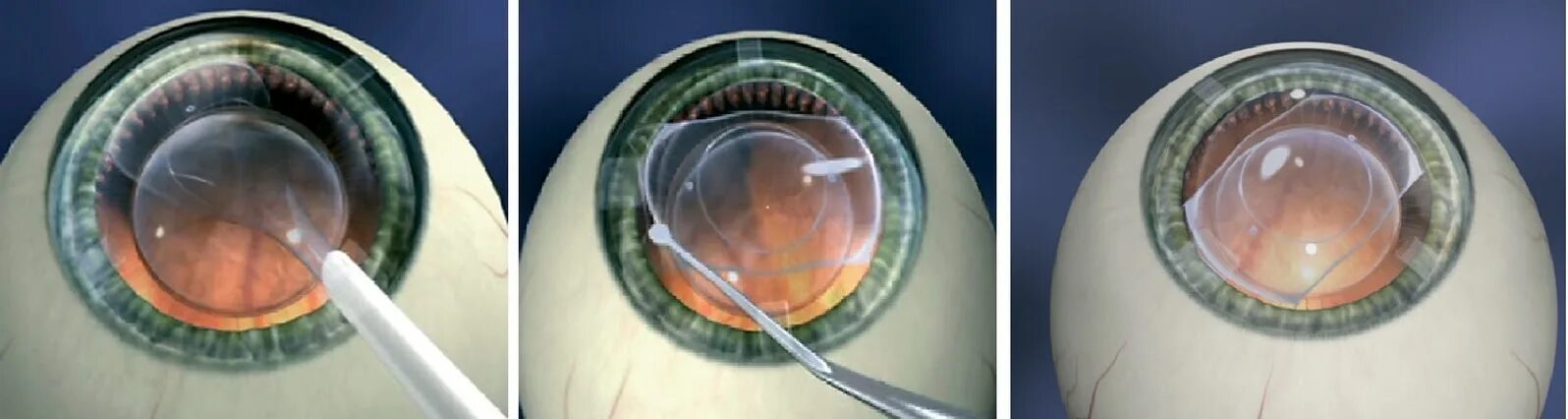 Воздух через глаз. Имплантация факичных интраокулярных линз. Факичные интраокулярные линзы (ИОЛ)..