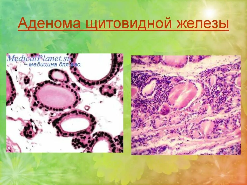 Раковый узел в щитовидной железе узи. Опухоли щитовидной железы классификация. Аденома щитовидной железы операции. Аденома щитовидной железы операции. Фолликулярная аденома щитовидной железы гистология.