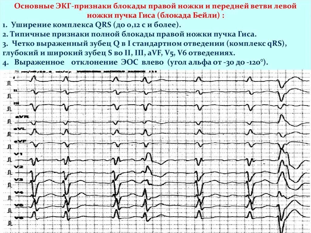 Признаки блокада левой ножки. ЭКГ при блокаде передней ветви левой ножки пучка Гиса (ЛНПГ). Блокада ЛНПГ на ЭКГ. Блокада задней ветви левой ножки пучка Гиса на ЭКГ. Блокада ПНПГ И передней ветви ЛНПГ на ЭКГ.