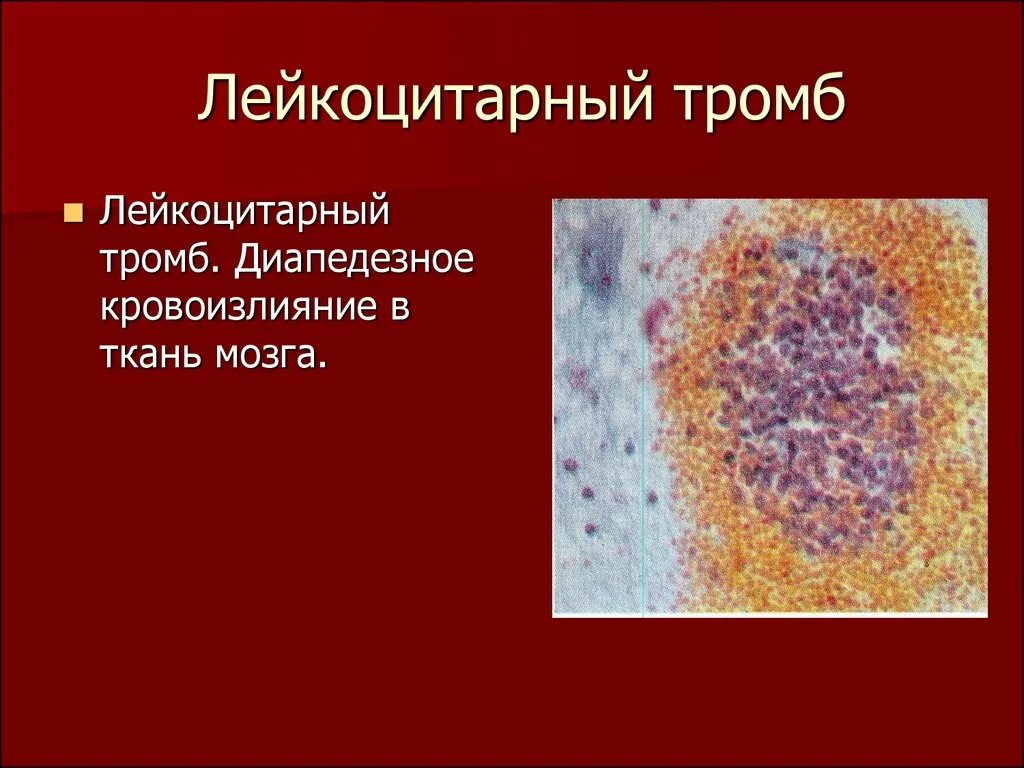 Диапедезные кровоизлияния. Диапедезные геморрагии. Тромб микропрепарат