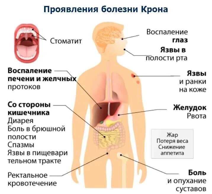 Болезнь крона симптомы у взрослых. Клинические проявления болезни крона. внекишечные симптомы болезни крона. болезнь крона факторы риска. болезнь крона клинические симптомы.