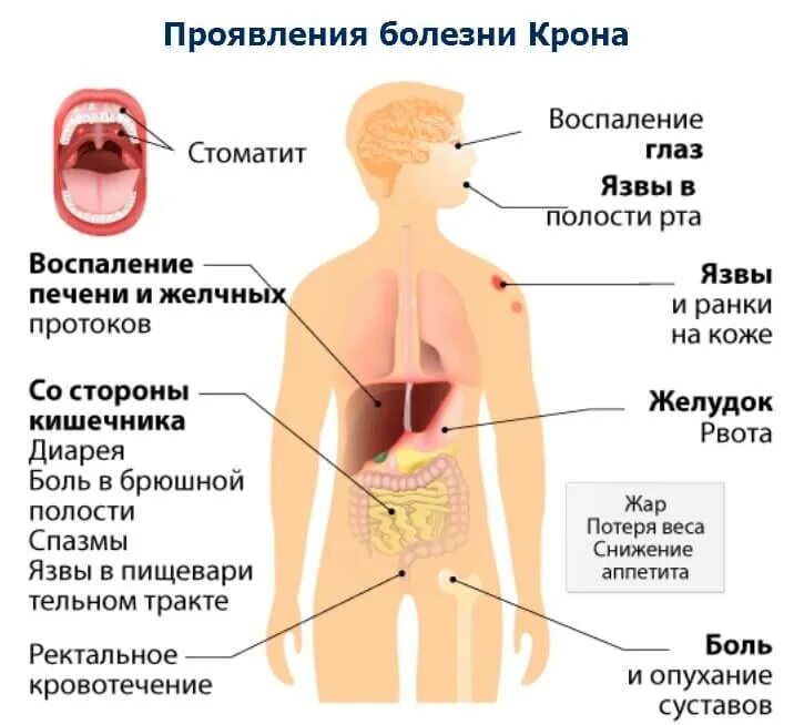 Болезнь крона клинические проявления. Болезнь крона факторы риска. Клинические проявления при болезни крона. Кишечные проявления болезни крона. Крона болезнь симптомы у женщин после 60