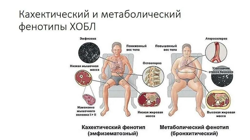 Поражение легких лечение. Лгхроническая обструктивная болезнь лёгких. Хроническая обструктивная болезнь легких симптомы. Основные клинические симптомы при ХОБЛ. ХОБЛ проявляется признаками.