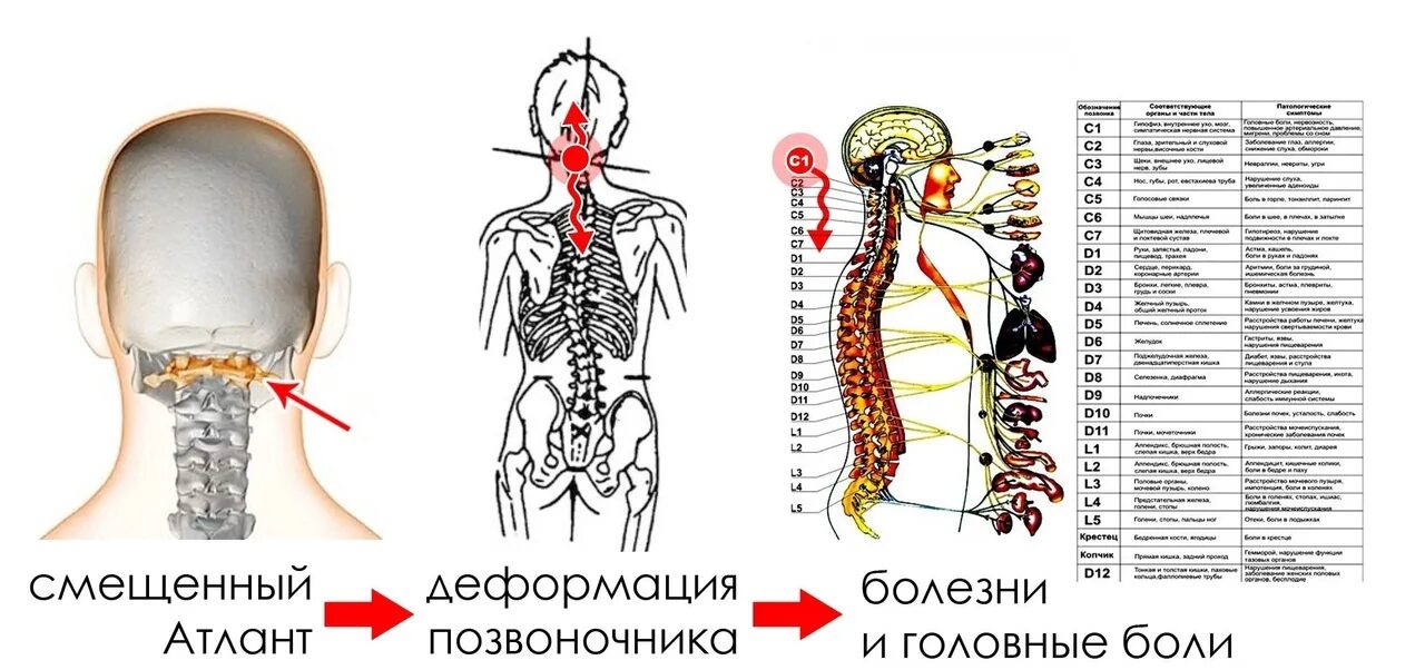Шейный позвонок Атлант вправление. Позвоночник Атлант вправление. Атлант шейный позвонок симптомы. Атлант в позвоночнике симптомы смещения.