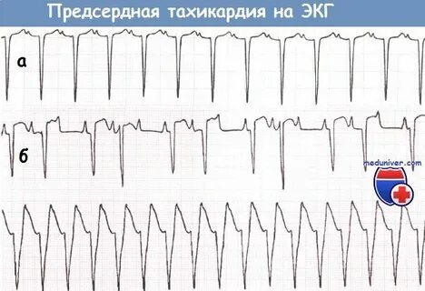 Берут ли с тахикардией