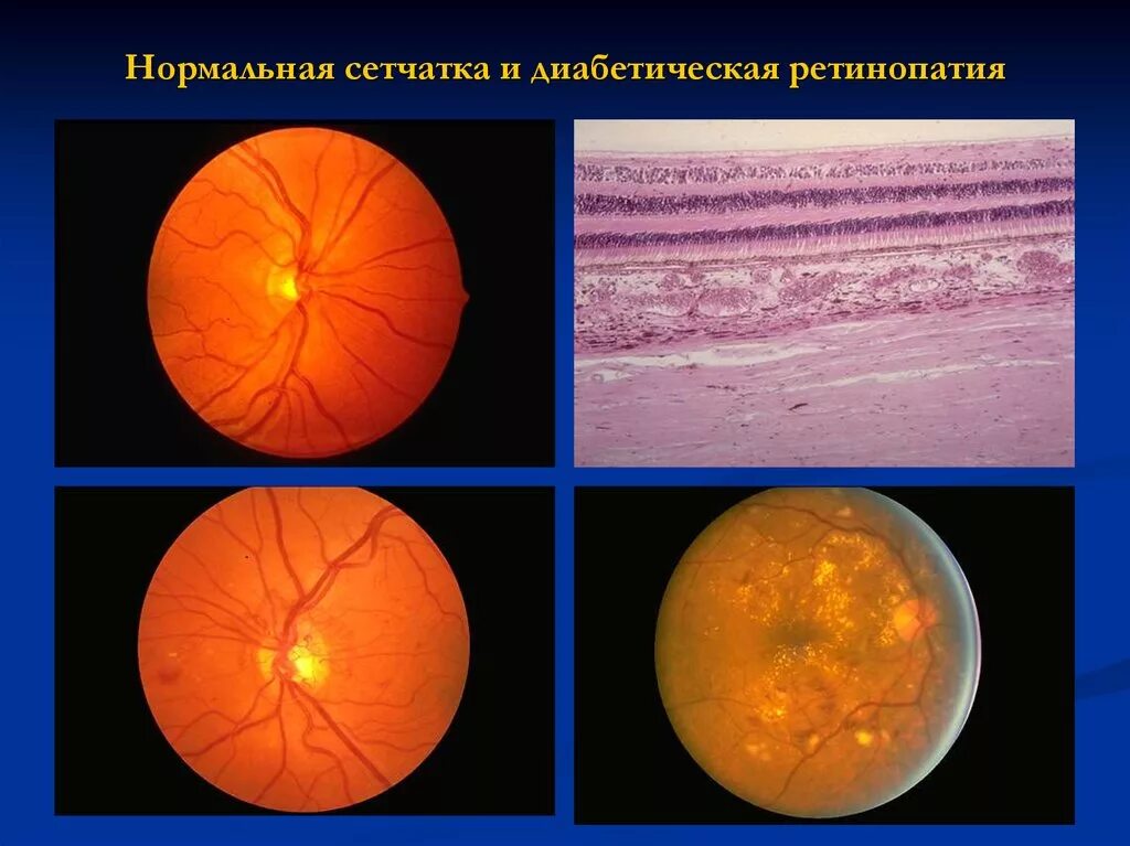 Функциональным центром сетчатки является. Непролиферативная диабетическая ретинопатия. диабетическая ретинопатия сетчатки. препролиферативная стадия диабетической ретинопатии. криокоагуляция сетчатки ретинопатия.