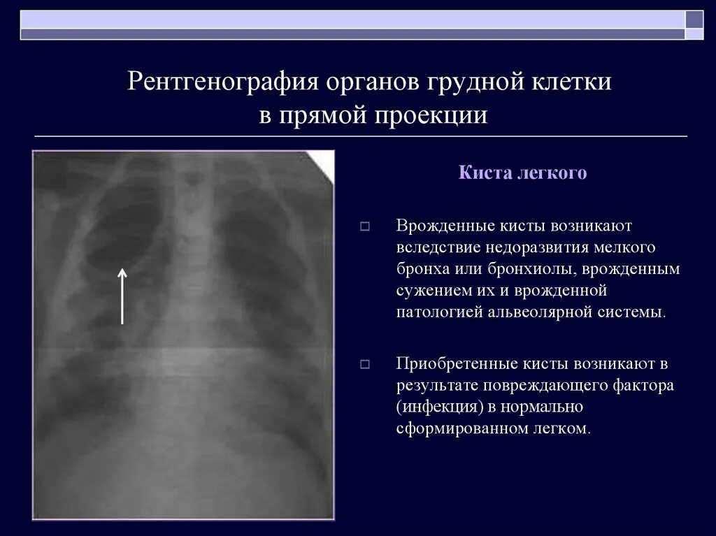 Рентген органов грудной клетки в прямой проекции.