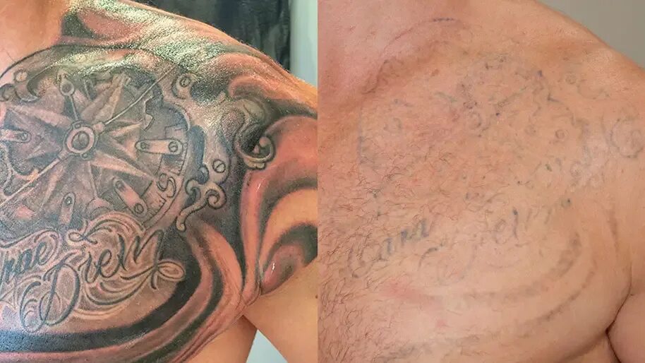 Sugar Land Laser Tattoo Removal Prices In Houston, TX Tattoo removal, Laser tatt