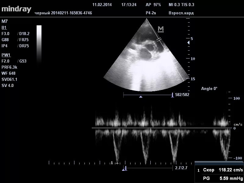 УЗИ сердца эхокардиография м режим. ЭХОКГ С режимами 4 d и TVI. ЭХОКГ 3д датчик. Эхо кс цена