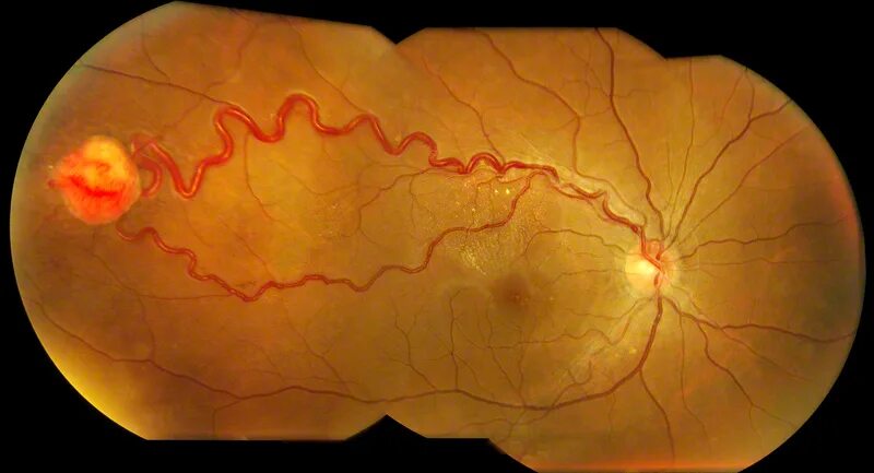 Синдром фон. Болезнь гиппеля линдау пациент. Болезнь гиппеля линдау сетчатка. Синдром фон. Болезнь гиппеля линдау.