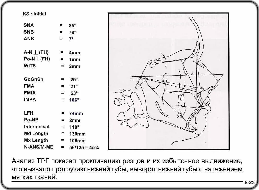 Wit перевести. Анализ ТРГ. Углы ТРГ ортодонтия. Точки ТРГ В ортодонтии. ТРГ схема.