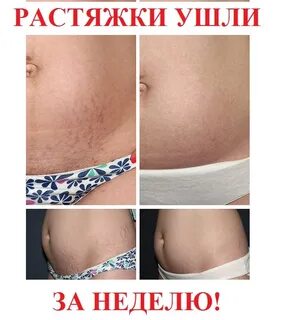 Растяжка родах