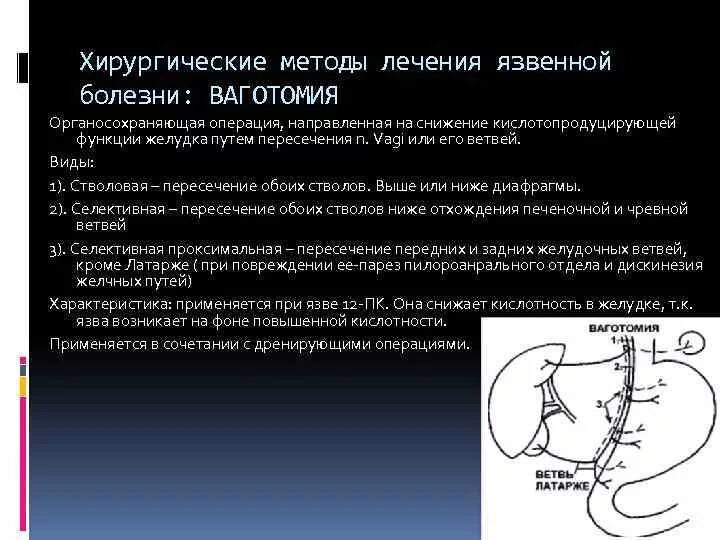 Язвенной болезни 12 перстной кишки операции. Ушивание язвы 12 перстной кишки. Ваготомия 12 перстной кишки. Органосохраняющие операции при язвенной болезни. Осложнения желудка 12 перстной кишки