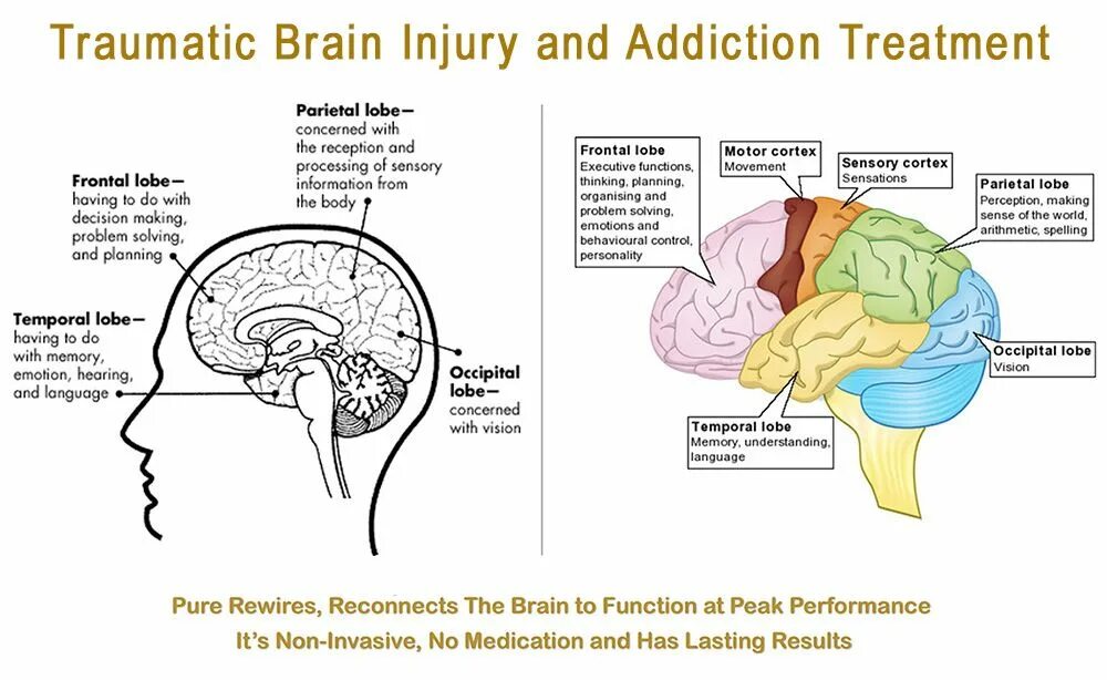 Traumatic brain. Post-traumatic Epilepsy. Understanding the Brain and Addiction.