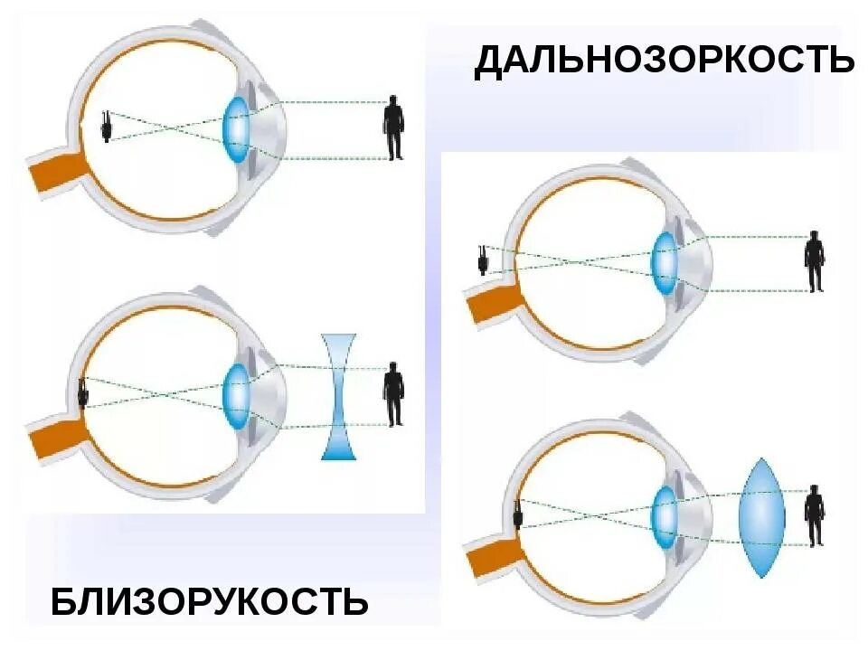 Какое зрение при дальнозоркости. Строение глаза при близорукости и дальнозоркости. Что такое близорукость (миопия) и дальнозоркость (гиперметропия). Строение глаза дальнозоркость. Строение глаза дальнозоркость с линзой.