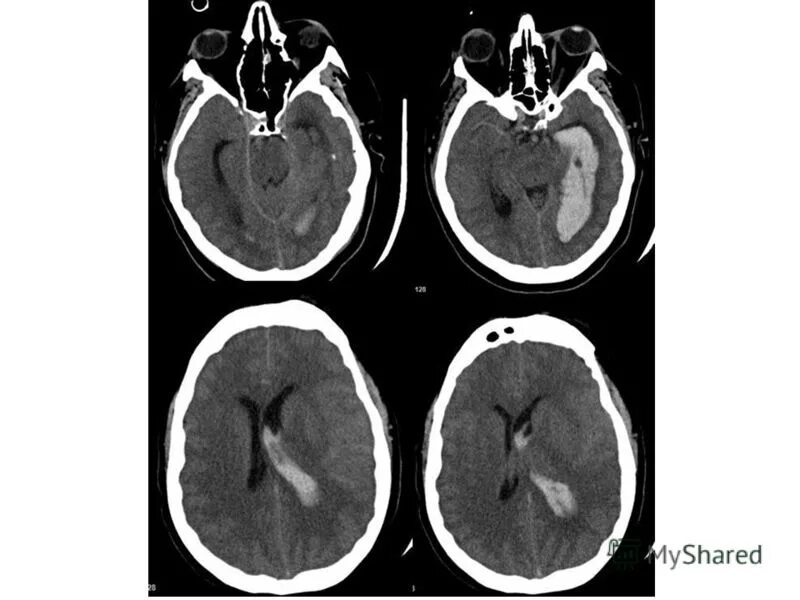 Аневризма перегородки у ребенка. Внутрижелудочковое кровоизлияние кт. Субарахноидальное кровоизлияние кт картина. Паравентрикулярное кровоизлияние. Внутричерепное кровоизлияние кт.