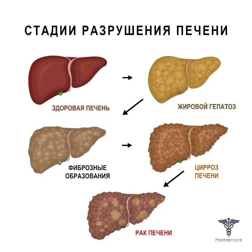 Жировое увеличение печени. Цирроз печени патоморфоз. Стадии гепатоза печени. Жировой гепатоз и цирроз. Жировой гепатоз 1 степени.