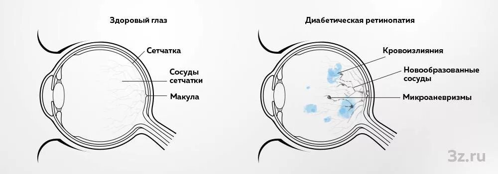 Катаракта глаза при сахарном диабете. Диабетическая ретинопатия сетчатки глаза. диабетическая ретинопатия глаз. зрение при сахарном диабете. влияние сахарного диабета на зрение.