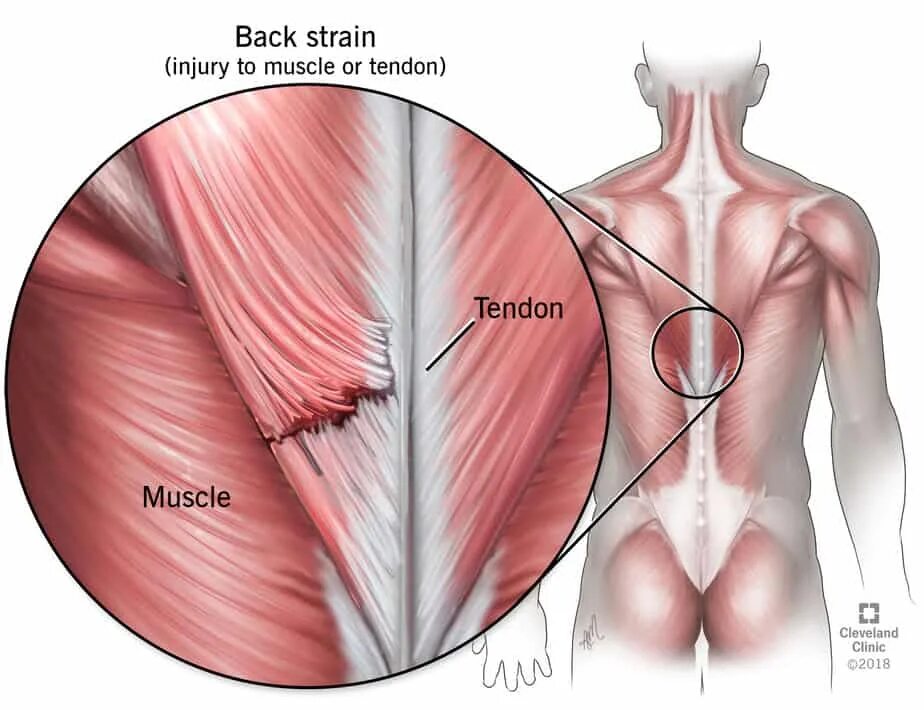 Лечение частичного разрыва мышц. Мышцы и сухожилия спины.
