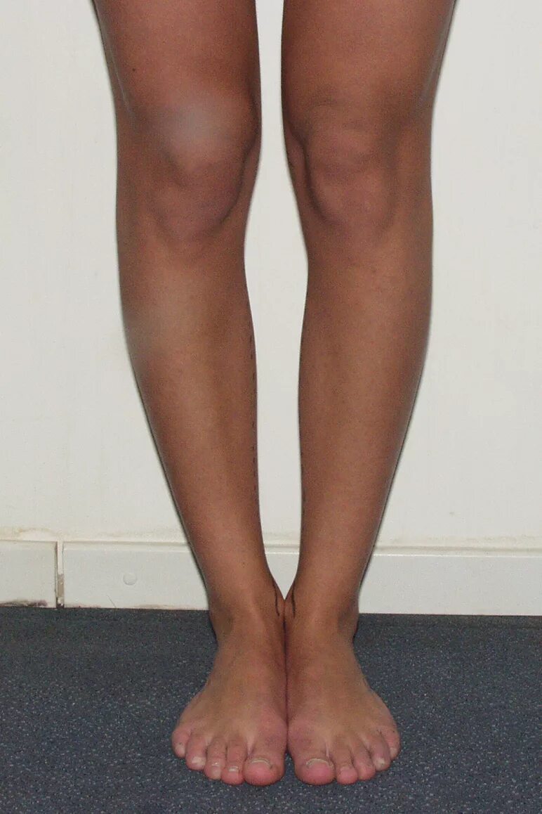 Коррекция деформаций стопы. Корректор халлюкс вальгус. Ortex 024 корректор большого пальца ноги отводящая шина. Коррекция деформаций стопы. Ортопедические стельки варус вальгус.