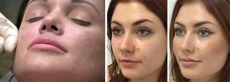 отек после липолитиков на лице. филлеры под глаза. андреищев малярпластика. малярные мешки. липофилинг щек до и после.