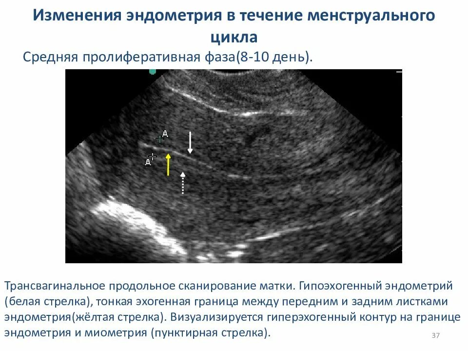 Пролиферативная фаза на УЗИ. Эндометрия пролиферативная фаза УЗИ. Эндометрий фазы цикла эндометрия менструационного. Трехслойный эндометрий на УЗИ.