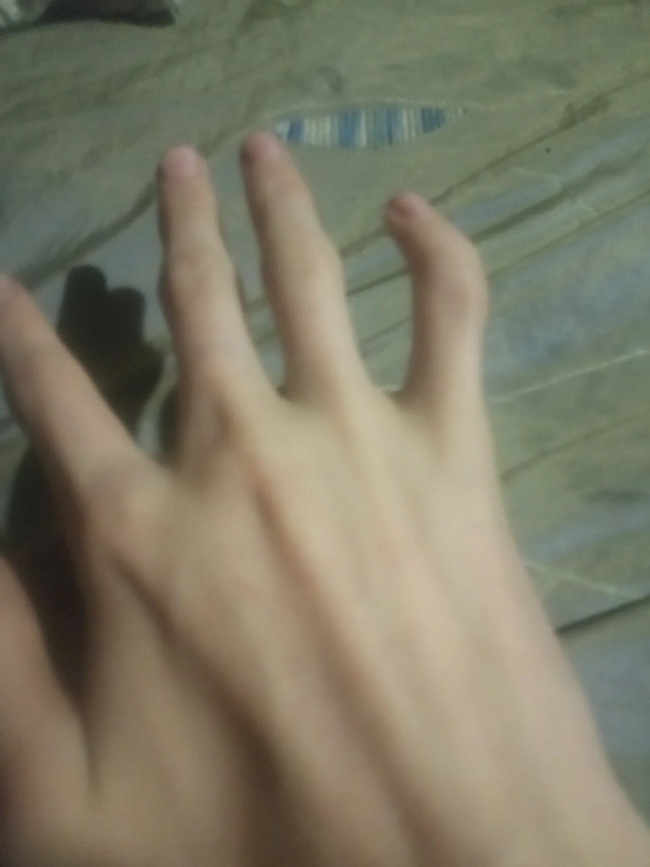 Загнул мизинец. Искривление мизинца на руке. Клинолактилия михинца. Клинодактилия 5 пальца. Загнул мизинец.