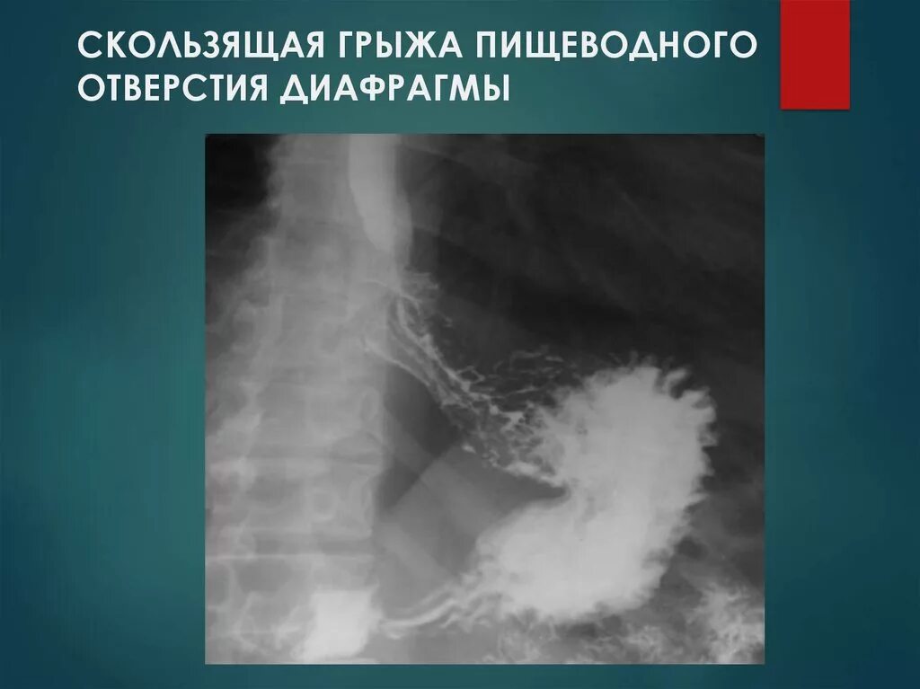 Грыжа пищеводного отверстия причины. Грыжа пищеводного диафрагмы. Скользящие и параэзофагеальные грыжи пищеводного отверстия. Скользящая аксиальная грыжа пищеводного отверстия 2 степени. Грыжа пищеводного отверстия диафрагмы ФГДС.