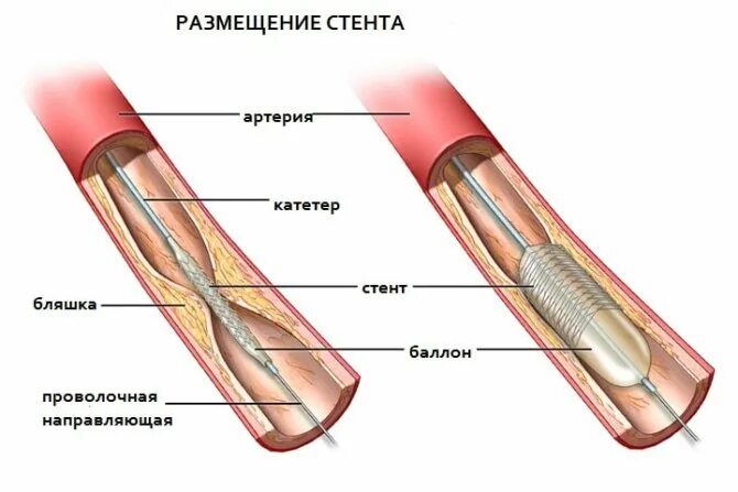 Стентирование коронарных артерий схема. Баллонная коронарная ангиопластика. Стентирование атеросклерозе артерий конечностей. Операция через сосуды