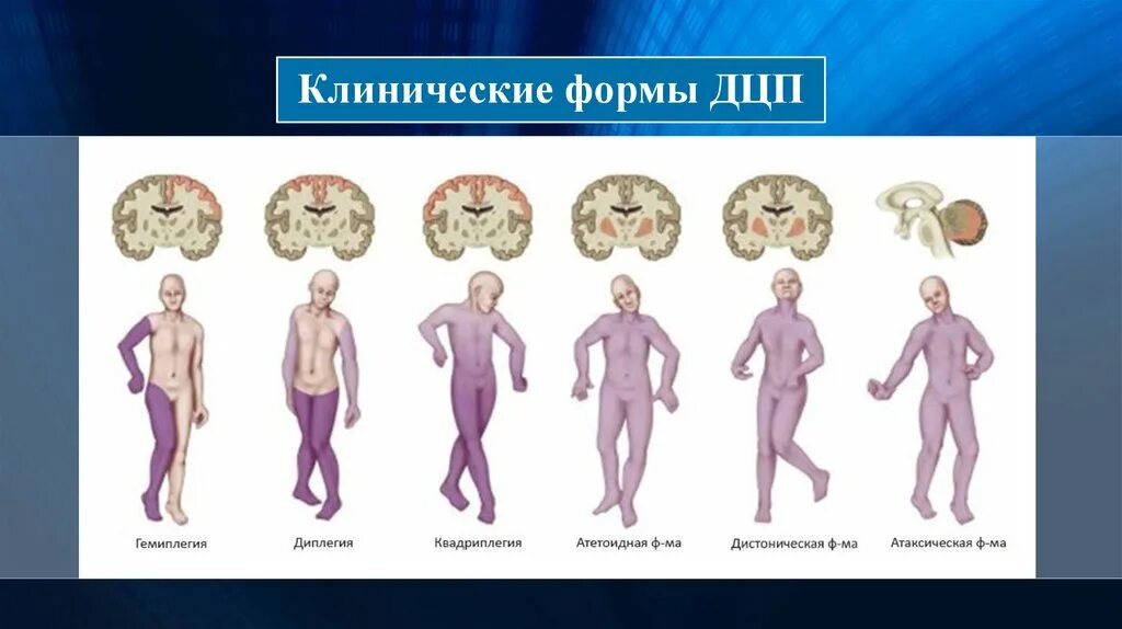 Гемипаретическая форма ДЦП. Спастический гемипарез. Клинические формы ДЦП У детей. ДЦП двойная гемипаретическая форма.