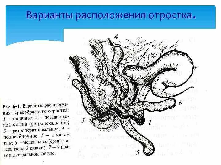 Аппендикс червеобразный. Ретроцекальное положение аппендикса. Червеобразный отросток анатомия расположение. Атипичное расположение отростка. Слепая кишка и червеобразный отросток.