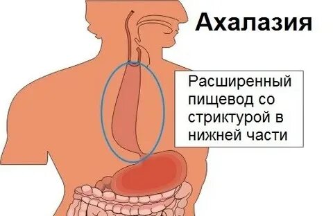 Что такое кардия и как лечить