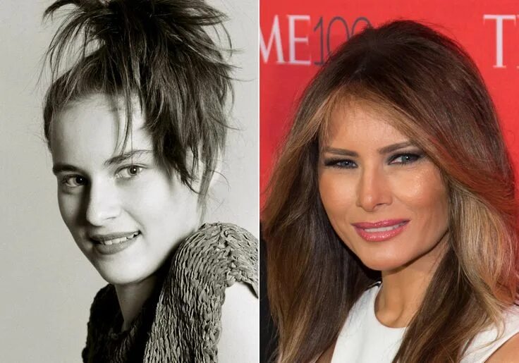 Melania Trump Plastic Surgery: A First Botox Lady?