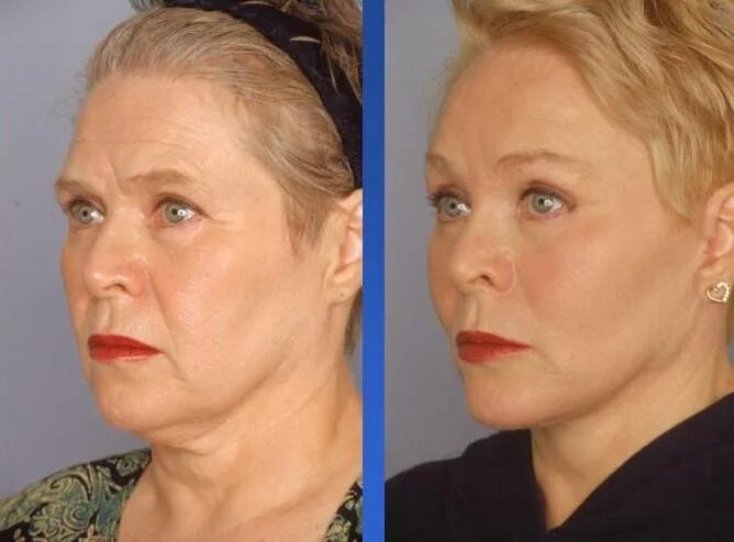 Мезо нити армирующие тредлифтинг. Операция смас лифтинг лица. Круговая подтяжка овала лица. Круговая пластика лица. Операция смас лифтинг лица.