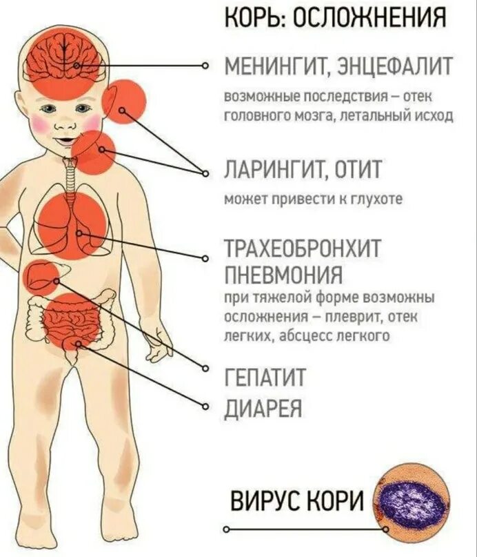 Вирусом называется корь. Вирусом называется корь