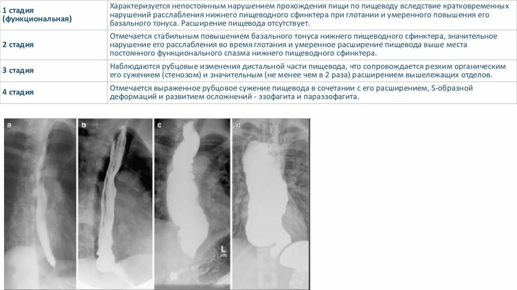 Застряло в пищеводе что делать