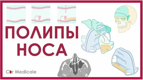 Лечение полипа без операции отзывы