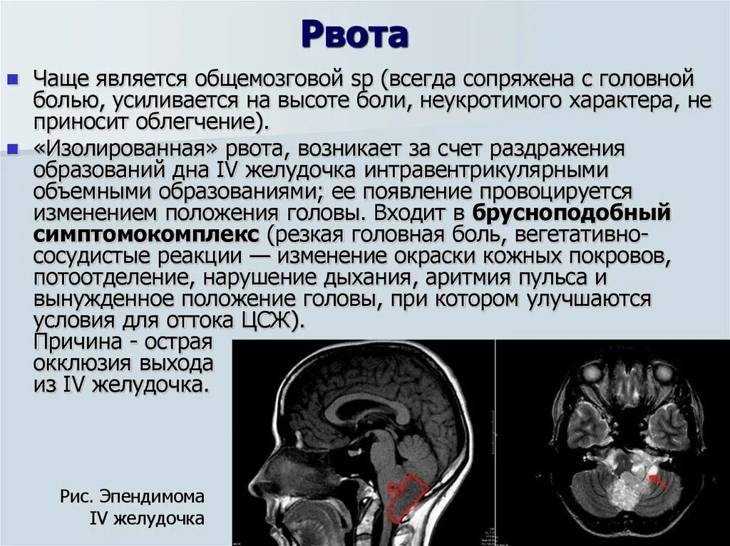 Синдромы опухолей головного мозга. Опухоли желудочков мозга. Объемное образование головного мозга. Синдромы при опухолях головного мозга.