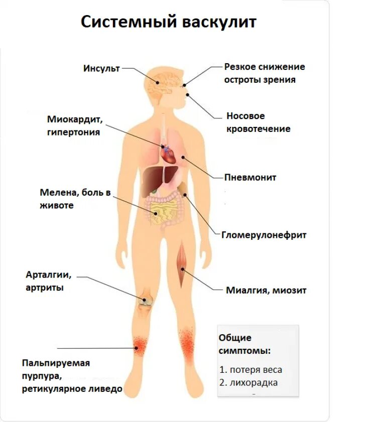 Системные васкулиты клинические. Клинические симптомы геморрагического васкулита. Васкулит сосудов проявление. Системный васкулит клинические симптомы. Системные васкулиты этиология.